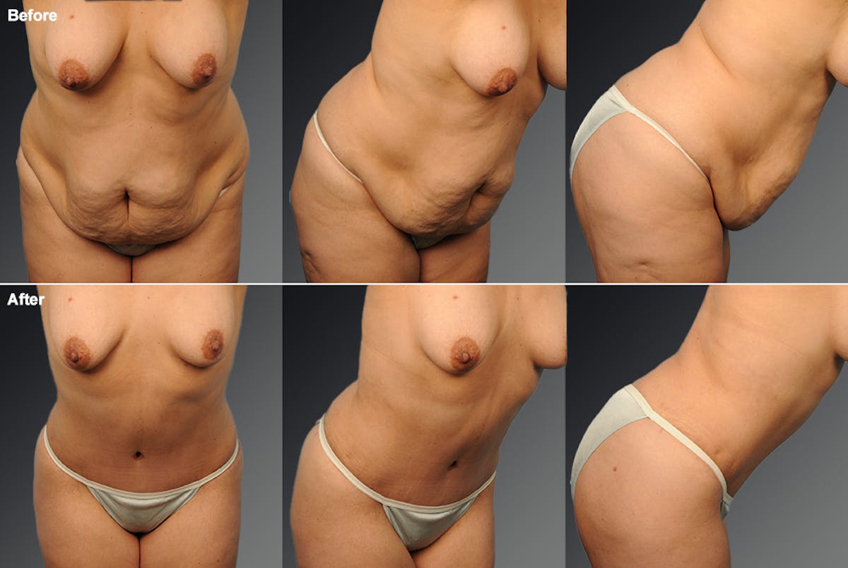 Tummy Tuck Before & After Gallery - Patient 237869 - Image 1