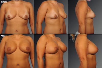 Breast Augmentation Before & After Gallery - Patient 300375 - Image 1