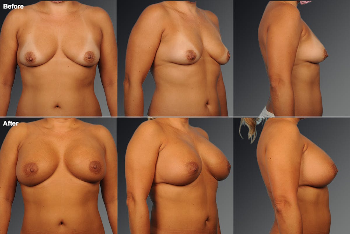 Breast Augmentation Before & After Gallery - Patient 300375 - Image 1