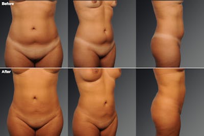 Liposuction Before & After Gallery - Patient 228226 - Image 1