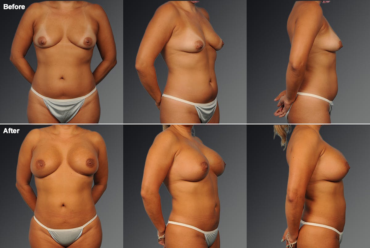 Mommy Makeover Before & After Gallery - Patient 322518 - Image 1