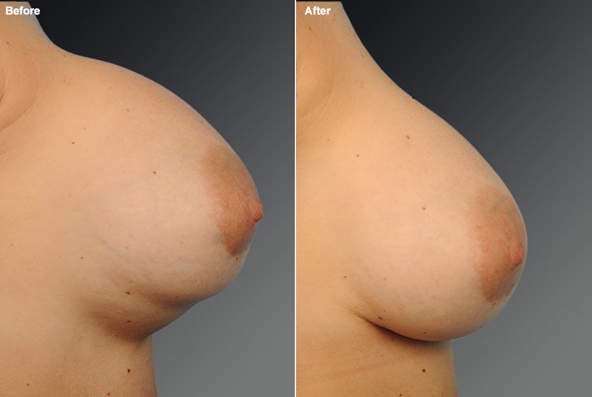 Malposition Before & After Gallery - Patient 217565 - Image 1