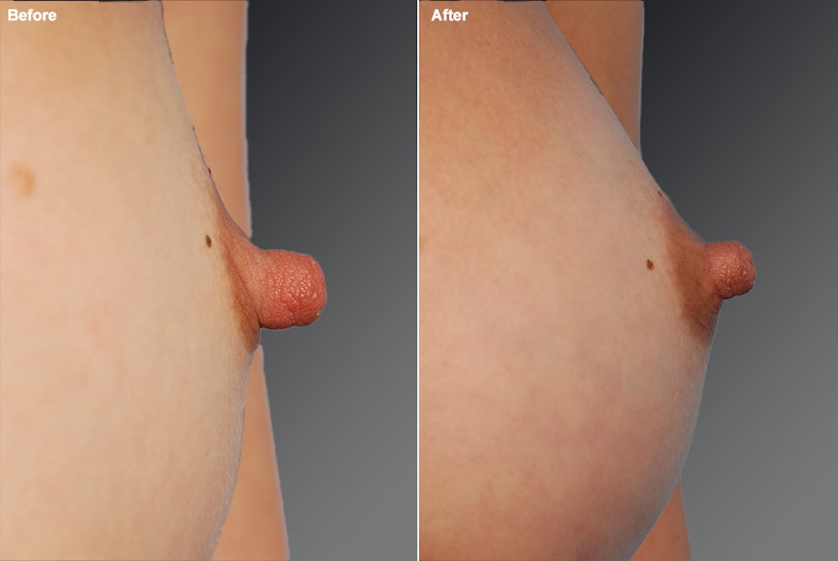 Nipple Reduction Before & After Gallery - Patient 310174 - Image 1