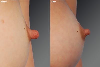 Nipple Reduction Before & After Gallery - Patient 310174 - Image 1