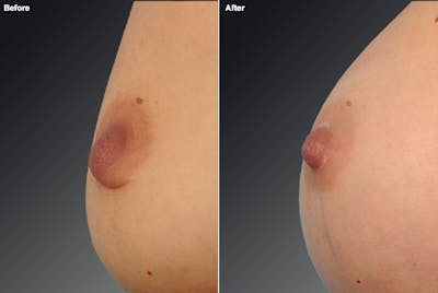 Inverted Nipple Before & After Gallery - Patient 237377 - Image 1