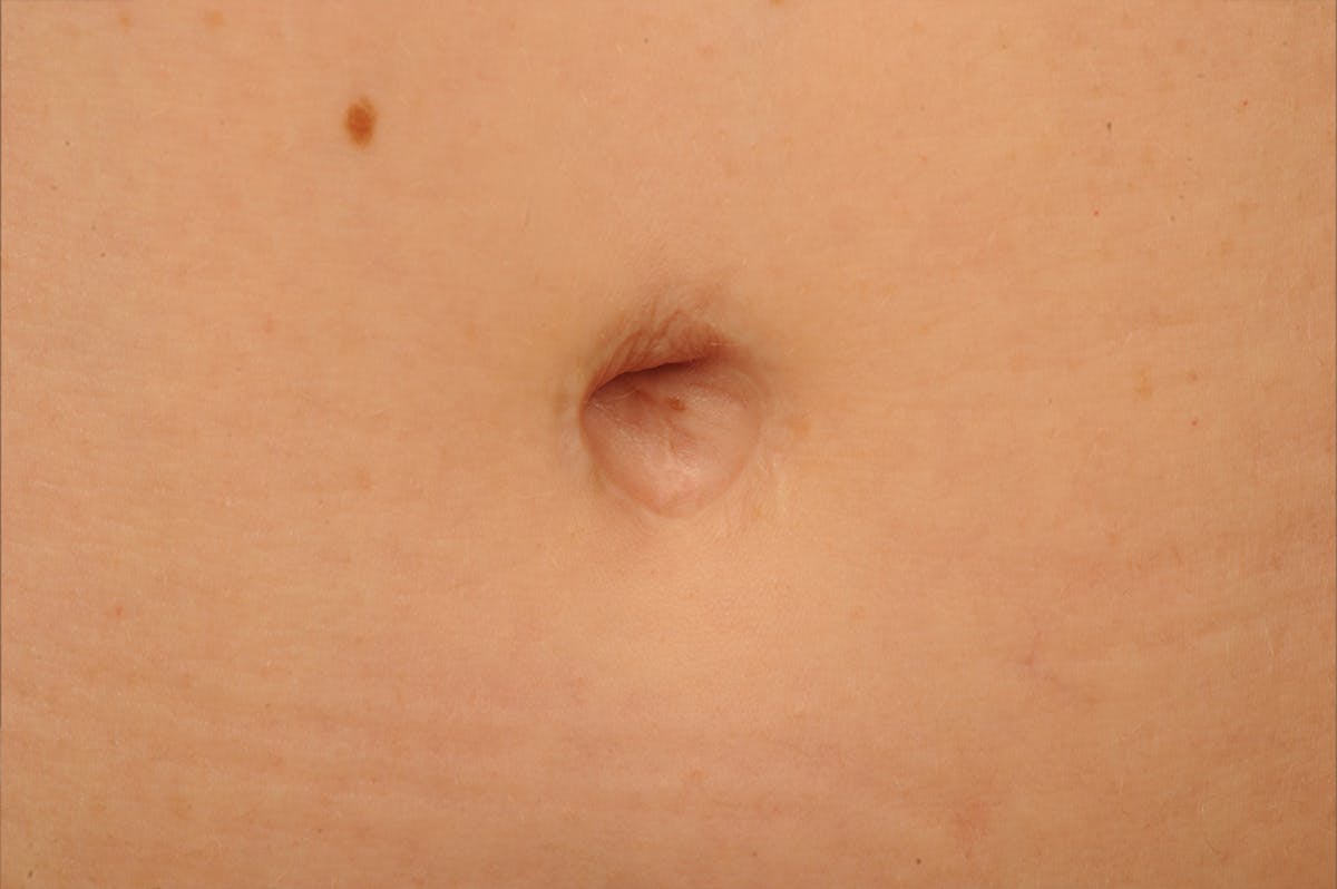 Body Scar Closeups Before & After Gallery - Patient 213342 - Image 1