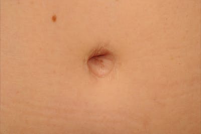 Body Scar Closeups Before & After Gallery - Patient 213342 - Image 1