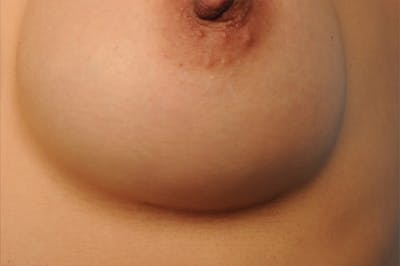 Body Scar Closeups Before & After Gallery - Patient 108435 - Image 1