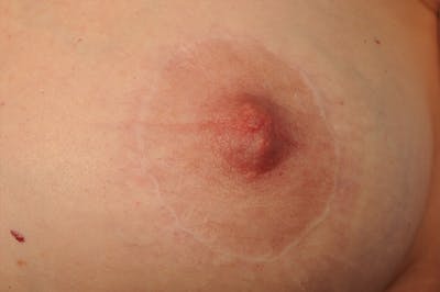 Body Scar Closeups Before & After Gallery - Patient 449801 - Image 1