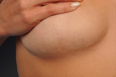 Body Scar Closeups Before & After Gallery - Patient 297422 - Image 1