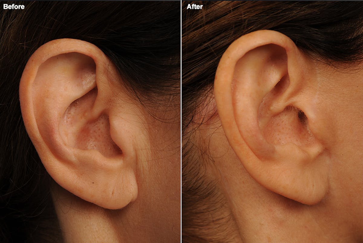 Body Scar Closeups Before & After Gallery - Patient 138104 - Image 1