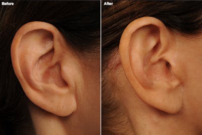 Body Scar Closeups Before & After Gallery - Patient 138104 - Image 1
