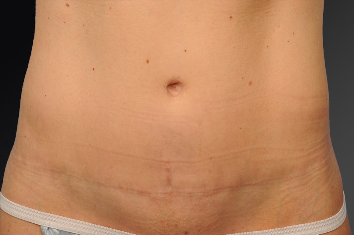 C-Section Scar Revision Before & After Gallery - Patient 136500 - Image 1
