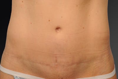 C-Section Scar Revision Before & After Gallery - Patient 136500 - Image 1