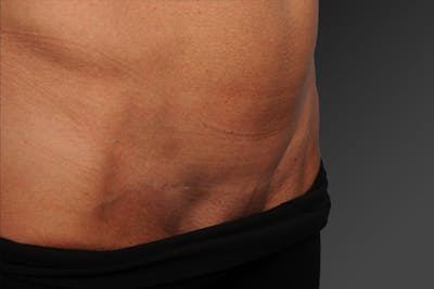 C-Section Scar Revision Before & After Gallery - Patient 131442 - Image 1