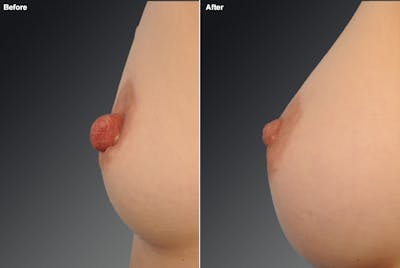 Nipple Reduction Before & After Gallery - Patient 232934 - Image 1