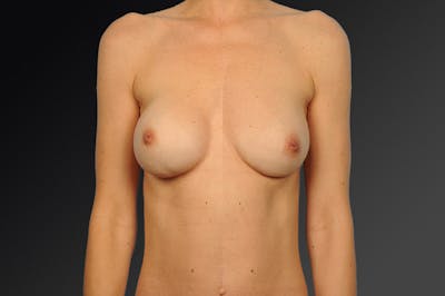 Explantation Before & After Gallery - Patient 401520 - Image 1