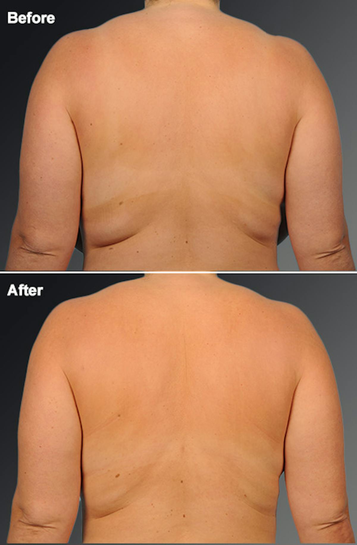 Liposuction Before & After Gallery - Patient 115594 - Image 1