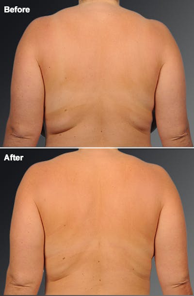 Liposuction Before & After Gallery - Patient 115594 - Image 1