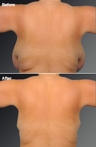 Liposuction Before & After Gallery - Patient 272828 - Image 1