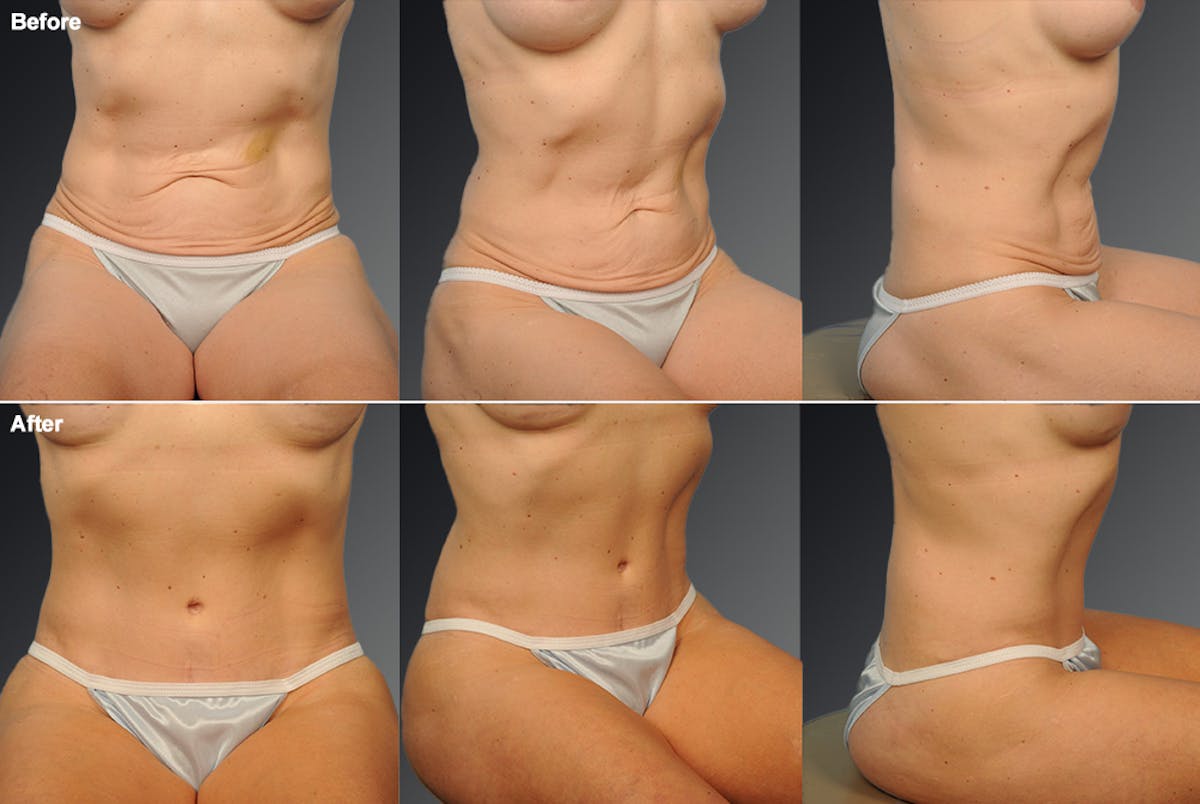 Tummy Tuck Before & After Gallery - Patient 746964 - Image 1