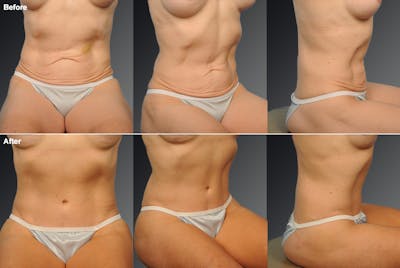 Tummy Tuck Before & After Gallery - Patient 746964 - Image 1