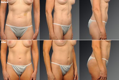 Tummy Tuck Before & After Gallery - Patient 160325 - Image 1