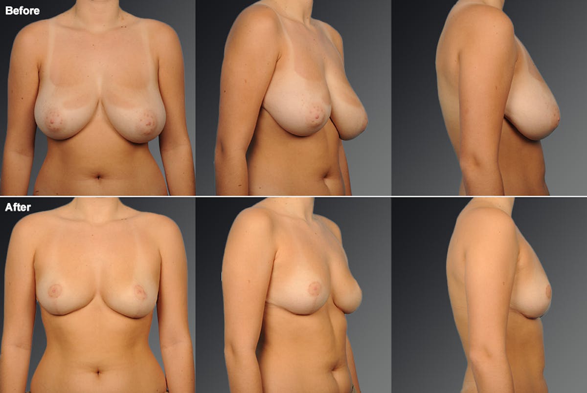 Standard Before & After Gallery - Patient 994819 - Image 1