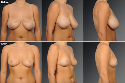 Standard Before & After Gallery - Patient 994819 - Image 1