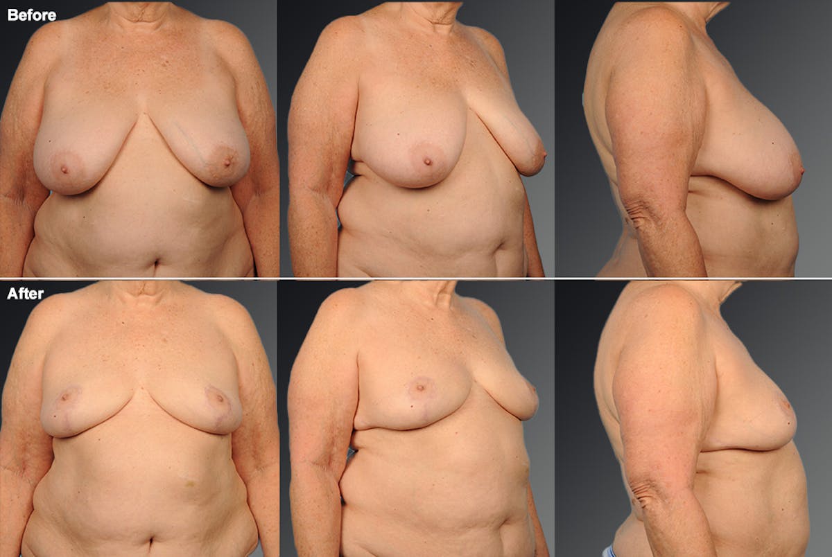 Standard Before & After Gallery - Patient 897753 - Image 1