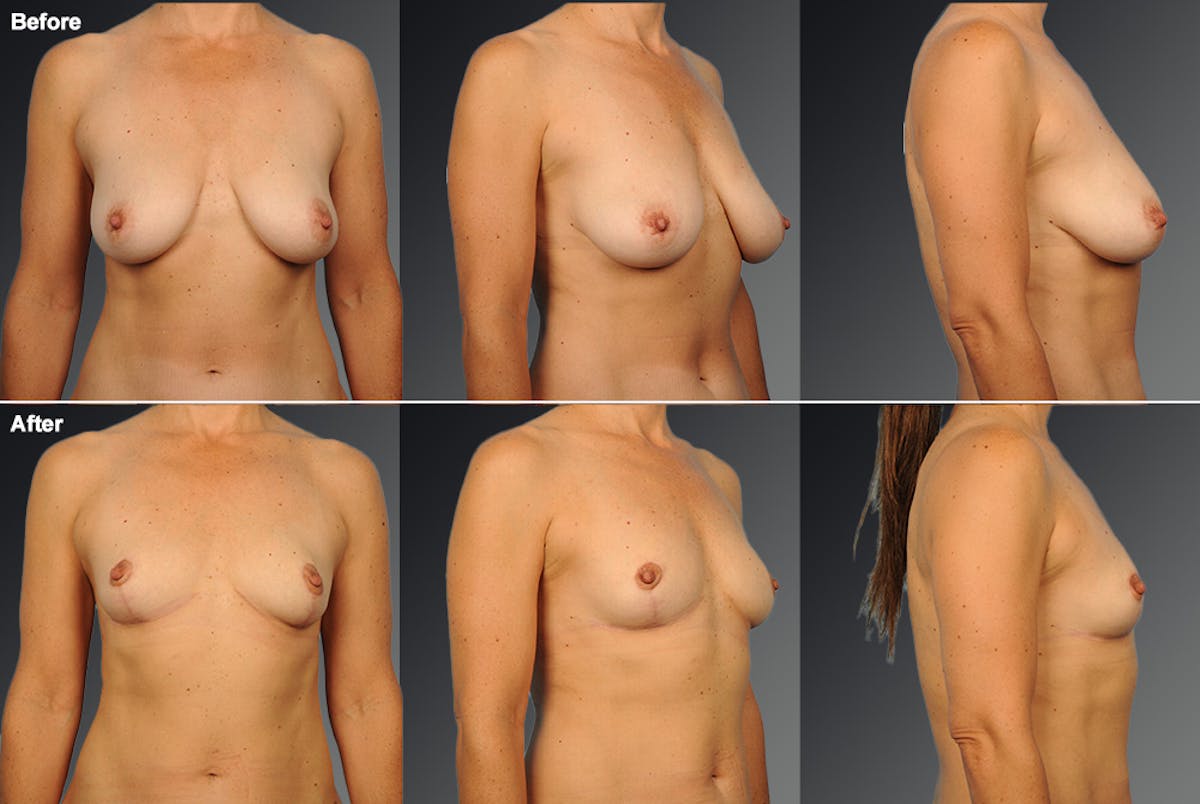 Standard Before & After Gallery - Patient 226171 - Image 1