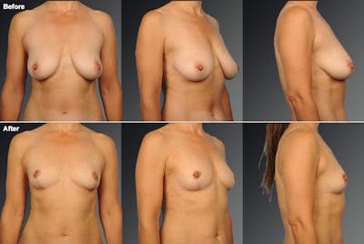 Standard Before & After Gallery - Patient 226171 - Image 1