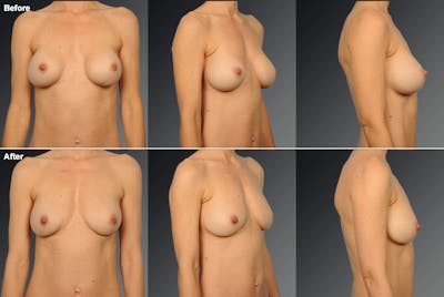 Malposition Before & After Gallery - Patient 258785 - Image 1