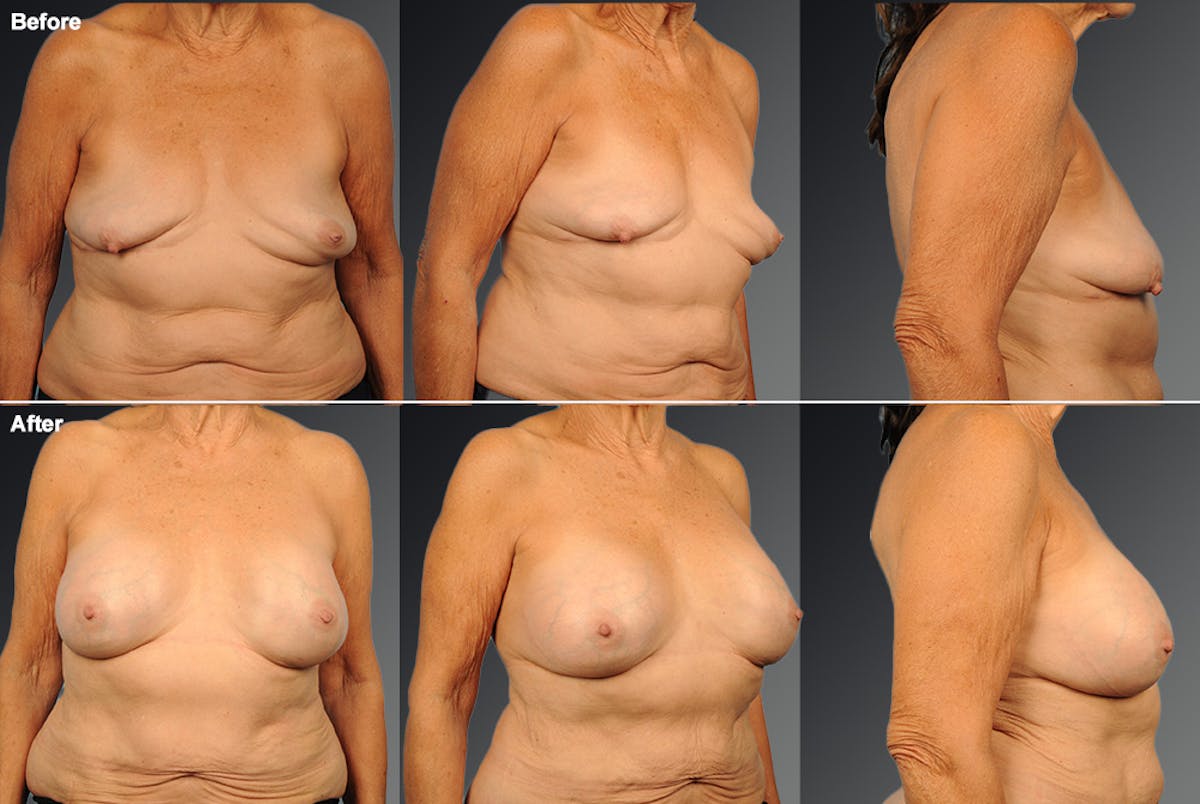 Replacement After Removal Before & After Gallery - Patient 902815 - Image 1