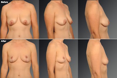 Breast Lift (Mastopexy) Before & After Gallery - Patient 271705 - Image 1