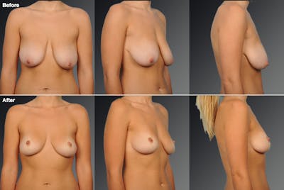 Breast Lift (Mastopexy) Before & After Gallery - Patient 246909 - Image 1