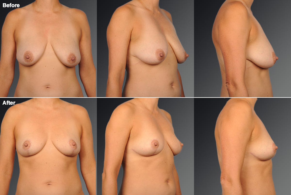 Breast Lift (Mastopexy) Before & After Gallery - Patient 138203 - Image 1