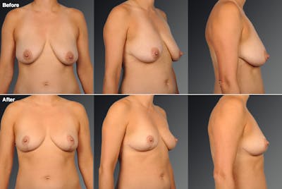Breast Lift (Mastopexy) Before & After Gallery - Patient 138203 - Image 1