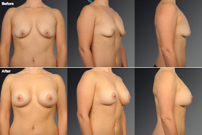 Breast Augmentation with Donut Lift Before & After Gallery - Patient 177851 - Image 1