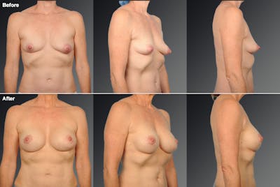 Breast Augmentation with Donut Lift Before & After Gallery - Patient 188948 - Image 1