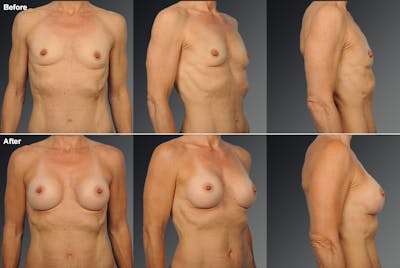 Breast Augmentation Before & After Gallery - Patient 297708 - Image 1