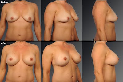 Breast Augmentation Before & After Gallery - Patient 483477 - Image 1