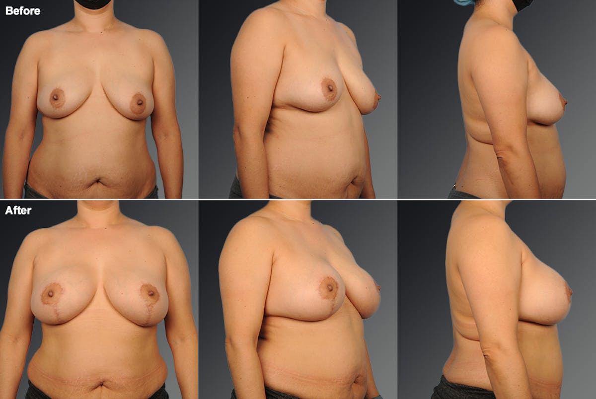Breast Augmentation with Donut Lift Before & After Gallery - Patient 331259 - Image 1