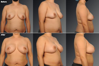 Breast Augmentation with Donut Lift Before & After Gallery - Patient 331259 - Image 1