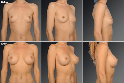 Breast Augmentation Before & After Gallery - Patient 217405 - Image 1