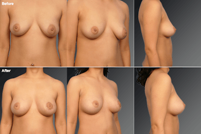 Breast Augmentation with Donut Lift Before & After Gallery - Patient 138287 - Image 1