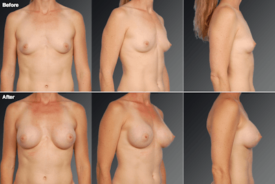 Breast Augmentation Before & After Gallery - Patient 359765 - Image 1