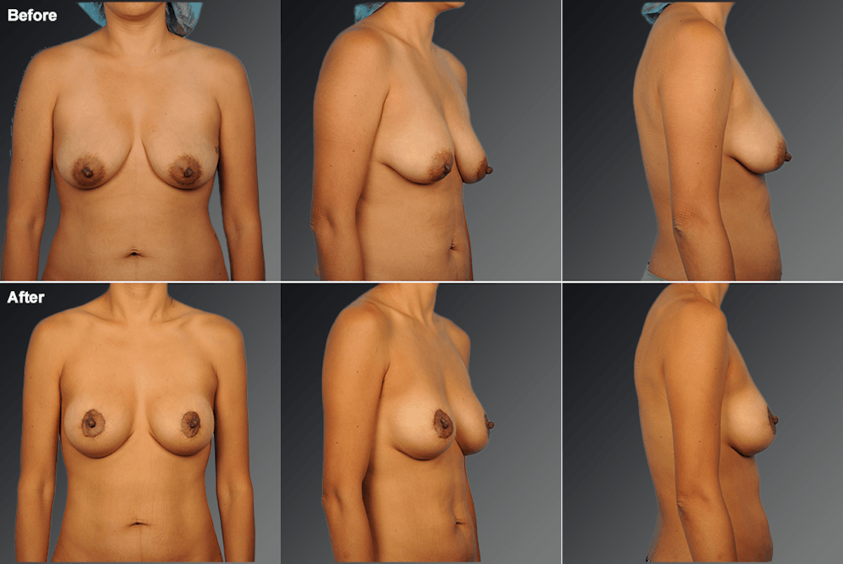 Breast Augmentation with Donut Lift Before & After Gallery - Patient 127474 - Image 1