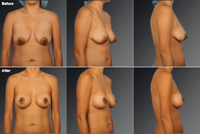 Breast Augmentation with Donut Lift Before & After Gallery - Patient 127474 - Image 1