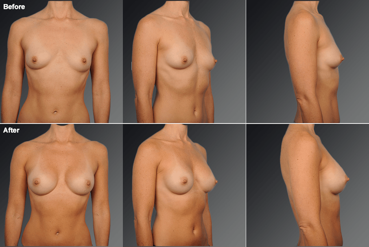 Breast Augmentation Before & After Gallery - Patient 161354 - Image 1